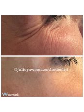 Wrinkle relaxing at Julie Pawson Aesthetics - Julie Pawson Aesthetics- Colne