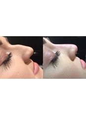 Non-surgical rhinoplasty at Julie Pawson Aesthetics - Julie Pawson Aesthetics