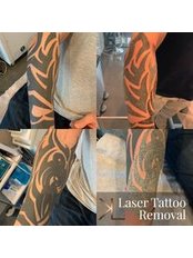 Tattoo Removal - Kerrie Lynch Aesthetics