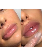 Lip Augmentation - MCR Aesthetics