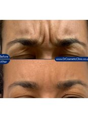 Treatment for Wrinkles - Dr Cosmetic Clinic - Manchester