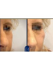 Cheek Augmentation - Dr Cosmetic Clinic - Manchester