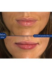 Lip Augmentation - Dr Cosmetic Clinic - Manchester