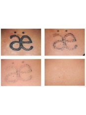 Laser Tattoo Removal Manchester - Tattoo Removal Manchester