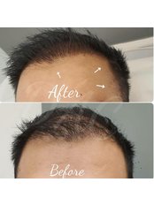 Hair loss plasma therapy including LED light  - Dermal Aesthetic Clinic