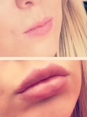 Dermal Fillers from  - Manchester Aesthetics