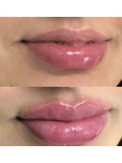 Lip Augmentation - Mirror Aesthetics
