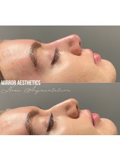 Non-Surgical Nose Job - Mirror Aesthetics