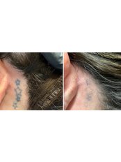 Tattoo Removal - Faded Ink and Faded Lines Aesthetics
