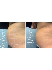 Fat Reduction Injections - Faded Ink and Faded Lines Aesthetics