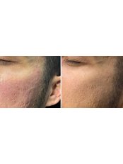 Microneedling - Faded Ink and Faded Lines Aesthetics