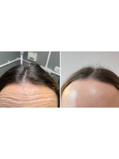 Treatment for Wrinkles - Faded Ink and Faded Lines Aesthetics
