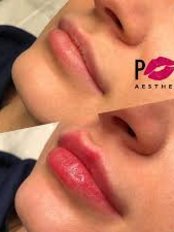 Lip Augmentation - Pout Aesthetics