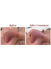 Laser and Pulsed Light Vein Treatment - The LASERINA clinic