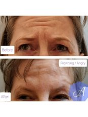 Treatment for Wrinkles - Aesthetic Harmony