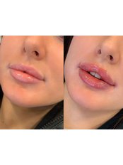 Lip Augmentation - Quaint Aesthetics