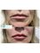 Defyne Aesthetics Skin & Laser Clinic - Smokers lines,  Nasolabial folds and lips 