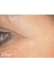 Treatment for Wrinkles Female - Defyne Aesthetics Skin & Laser Clinic