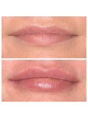 Lip Augmentation - Defyne Aesthetics Skin & Laser Clinic