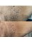 Defyne Aesthetics Skin & Laser Clinic - Straight after skin tag removal  