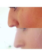 Non-Surgical Nose Job - Defyne Aesthetics Skin & Laser Clinic