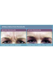 Treatment for Wrinkles - JS Cosmetics Surgery