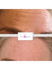 Anti Wrinkle Injections - Beauty Perfection Aesthetics