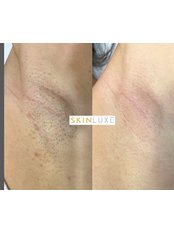 Laser Hair Removal - SkinLuxe