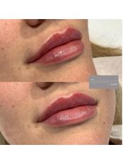 Lip Fillers - The Aesthetic Rooms