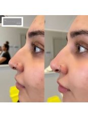 Non-Surgical Nose Job - The Aesthetic Rooms