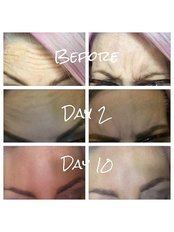 2 areas of wrinkle injections - The Aesthetic Rooms