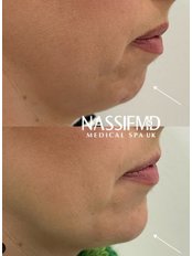 Chin Augmentation - NassifMD Medspa UK,