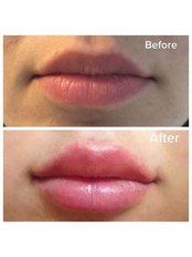Lip fillers - Pure Aesthetics by Zoe
