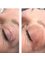 Lindo Aesthetics - Plasma Pen Upper eyelid Lift 