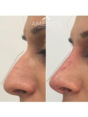 Non-Surgical Nose Job - Amedics