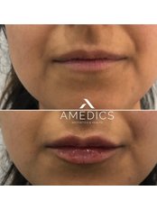 Lip Augmentation 0.6ml - Amedics