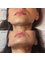 Perfection Co Aesthetics - Jaw filler before & after to conceal jowls 