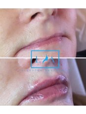 Lip Augmentation - Leicester Aesthetics