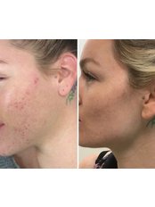 Microneedling - The Beauty Haven