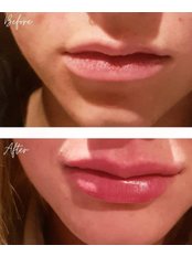 Lip Augmentation - Dr Fernando Aesthetics & Wellness