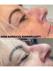 Non-Surgical Nose Job - Rejuvenate Skincare Aesthetics