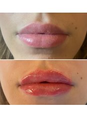Lip Augmentation (Juvederm Smile) - Rejuvenate Skincare Aesthetics