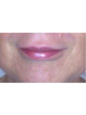 Lip Augmentation - Rutland Cosmetic Clinic