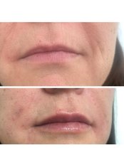 Lip Augmentation - Karen Brereton Aesthetics