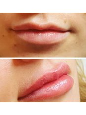 Lip Augmentation - Gina Collins Beauty Clinic