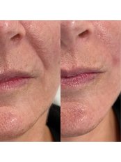 Nasolabial Folds Treatment - THE AESTHETIC LAB LINCOLN