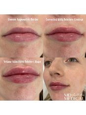 Lip Filler - THE AESTHETIC LAB LINCOLN