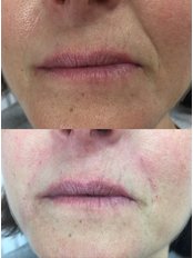 Nasolabial Folds Treatment - THE AESTHETIC LAB LINCOLN