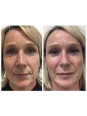 Tear Trough Under-eye Filler - THE AESTHETIC LAB LINCOLN