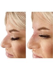 Non-surgical Rhinoplasty - THE AESTHETIC LAB LINCOLN